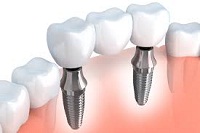 est Dental Implant in Maroda Camp Moharibhata | Ashish Dental Care